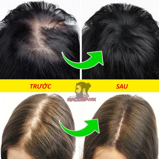 Dung Dịch Mọc Tóc Minoxidil 2% của Bailleul Pháp